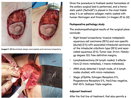 TachoSil® Clinical Cases Gynecological Surgery
