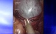 Ovarian Cystectomy - SILS