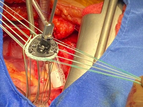 CABG + LV Aneurysm Repair + MV Repair
