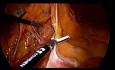 Laparoscopic TaTME Proctocolectomy