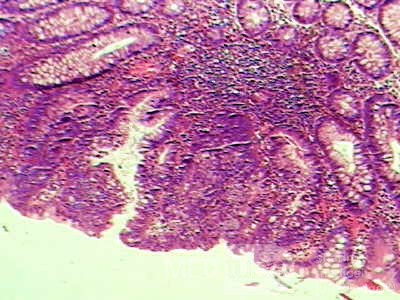 Trichuris Trichuris (whipworm) (10 of 10)