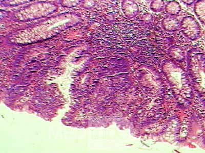 Trichuris Trichuris (whipworm) (10 of 10)
