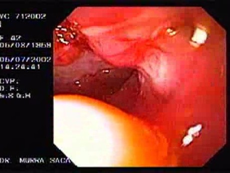 Crohn´s Disease (18 of 28)