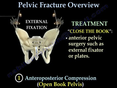 Pelvic Fractures - Video Lecture