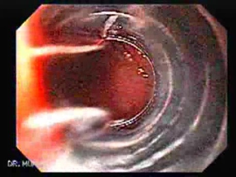 Gastrointestinal Stromal Tumor - GIST (4 of 65)