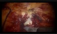 Robot-Assisted Radical Cystectomy