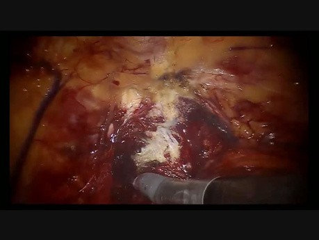 Robot-Assisted Radical Cystectomy