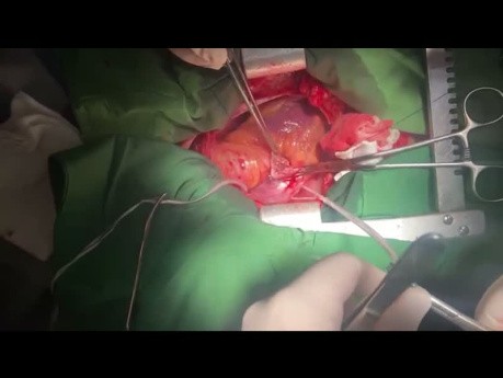 Off Pump Tricuspid Valve Surgery in Patient with Bacterial Endocarditis