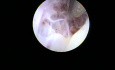 Bone metaplasia in a postmenopausal patient