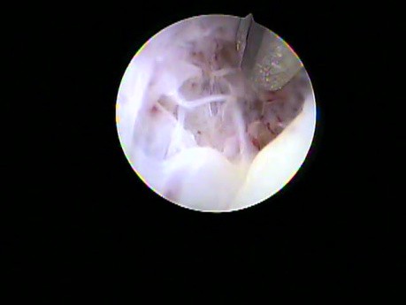 Bone metaplasia in a postmenopausal patient