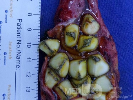 Laparascopic Cholecystectomy with Multiple Stones
