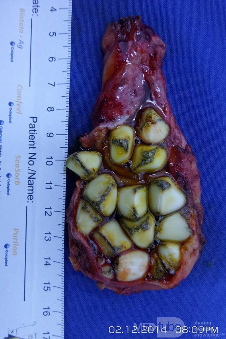 Laparascopic Cholecystectomy with Multiple Stones