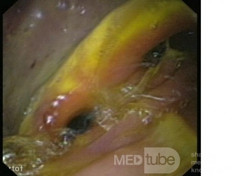 Endoscopic Image Of Postoperative State After Billroth's Operation II