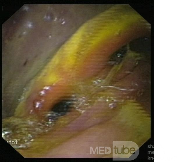 Endoscopic Image Of Postoperative State After Billroth's Operation II