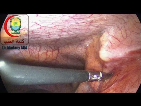 Rt Hypochondrial Port May Be Inserted Before The Complete Insertion Of The Epigastric Port