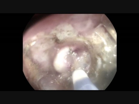 ESD of Distal Rectal LST in Patient after Liver Transplant