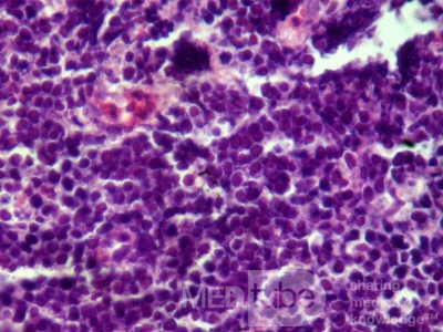 Gastroduodenal MALToma (12 of 12)