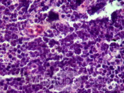 Gastroduodenal MALToma (12 of 12)