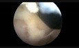 1 CLA Lt Stenosis Disectomy