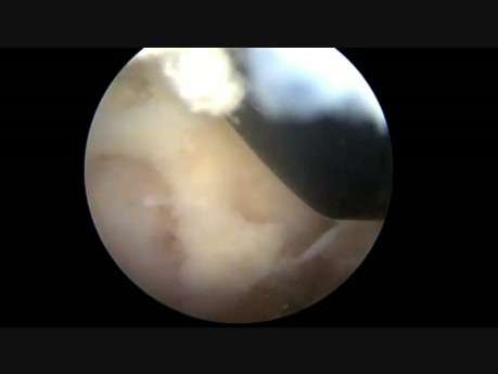 1 CLA Lt Stenosis Disectomy