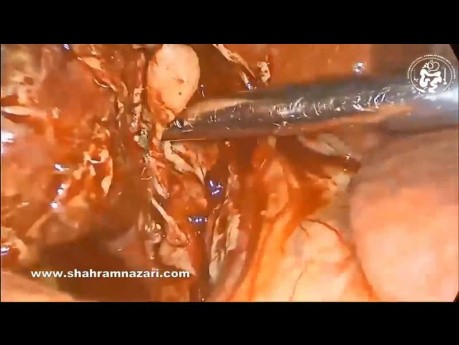 Laparoscopic Cholecystectomy for Gangrenous Cholecystitis