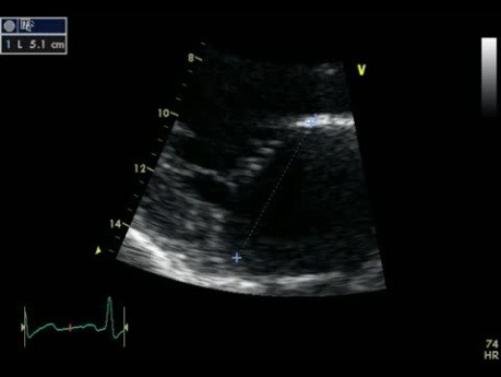 Mitral Regurgitation