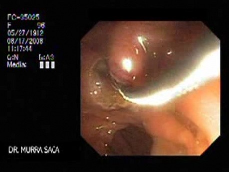 Acute Suppurative Cholangitis (5 of 8)