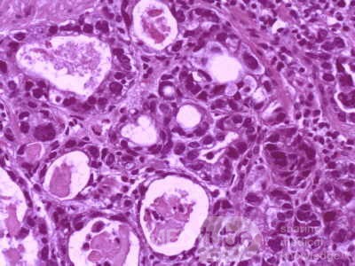 Gallbladder Adenocarcinoma and litiasis (12 of 13)