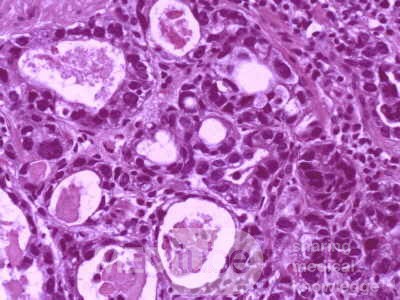 Gallbladder Adenocarcinoma and litiasis (12 of 13)