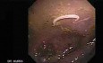 Aswhipworm in the cecum