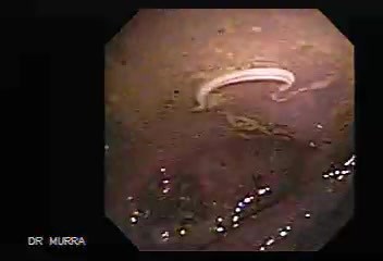 Aswhipworm in the cecum