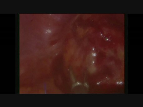 SILS - Restoration of the digestive tract