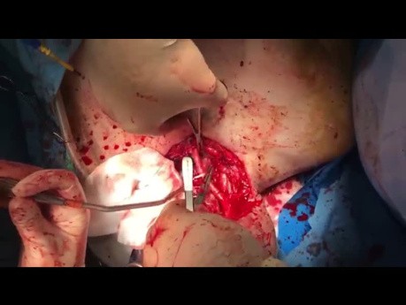 Patient with Patatracheal Invasion Vascular Laryngeal Tumor Undergone Extensive Neck Dissection 