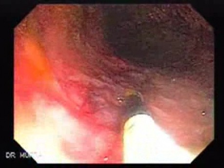 Multiple Rectal Ulcers (20 of 110)