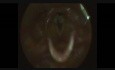 Intubation Granuloma
