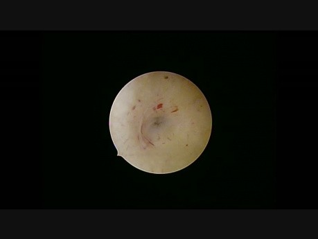 Essure Sterilisation with Mirena in Situ