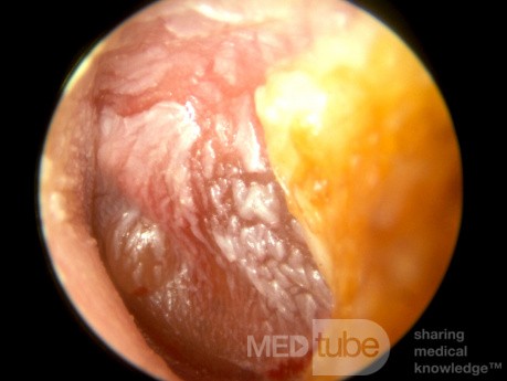 Severe Acute Otitis Media with Infected Tympanic Membrane