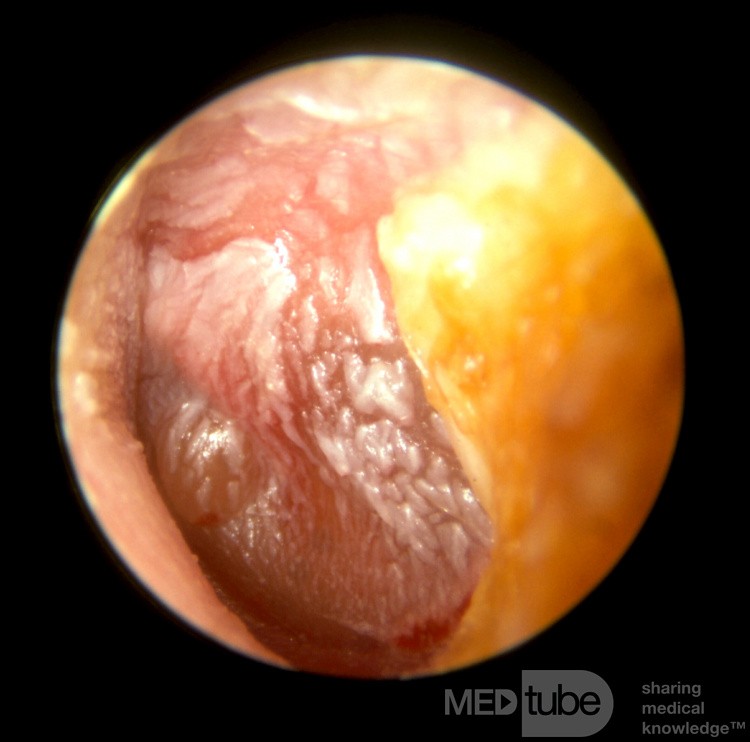 Severe Acute Otitis Media with Infected Tympanic Membrane