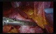 Peripheral Laparoscopic Gastrectomy