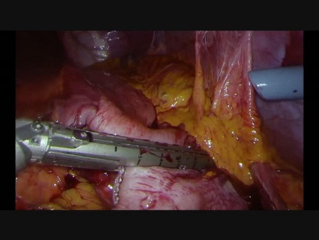 Peripheral Laparoscopic Gastrectomy
