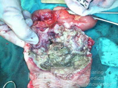 Non-Hodgkin's Lymphoma of the Colon (10 of 16)