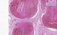 Prostate - Blood Vessels - Organizing Thrombi