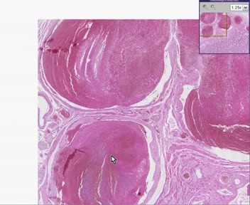 Prostate - Blood Vessels - Organizing Thrombi