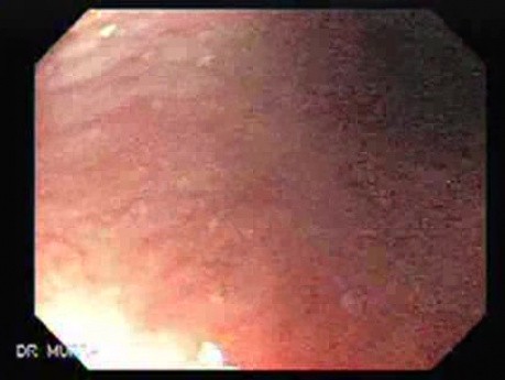 Glycogenic Acanthosis - Hyperplastic Squamous Epithelium