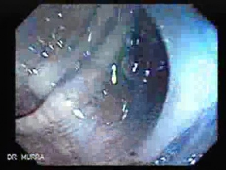 Sigmoid Diverticulitis - Colovesical Fistula (5 of 8)