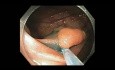 Colonoscopy - Ascending Colon - Twin Lesion EMR and Closure