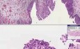 Transitional Carcinoma-in-situ - Histopathology - Bladder 