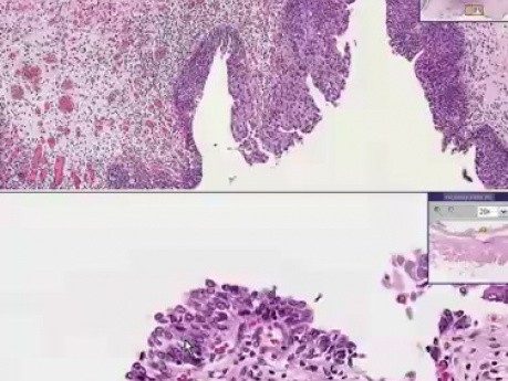 Transitional Carcinoma-in-situ - Histopathology - Bladder 