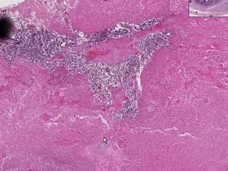 Embryonal carcinoma