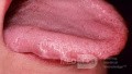 Crenellated Tongue